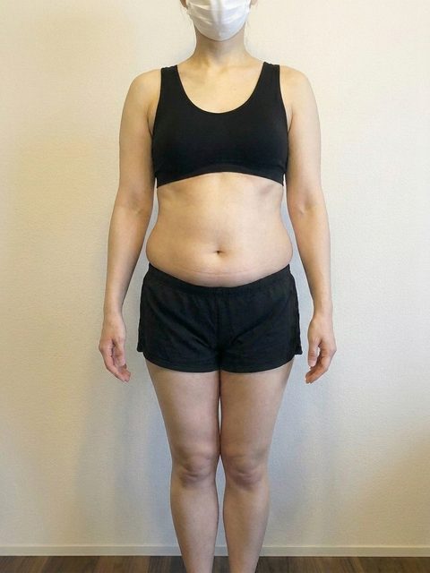 Case 1 before Mounjaro treatment