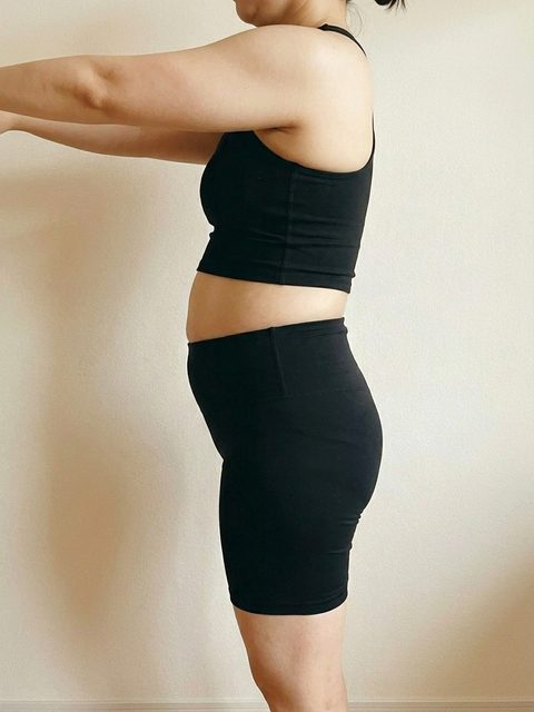 Case 2 before Mounjaro treatment