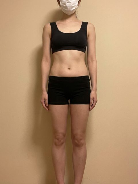 Case 3 after 4 months of Rybelsus treatment