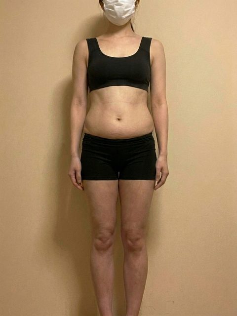 Case 3 before Rybelsus treatment