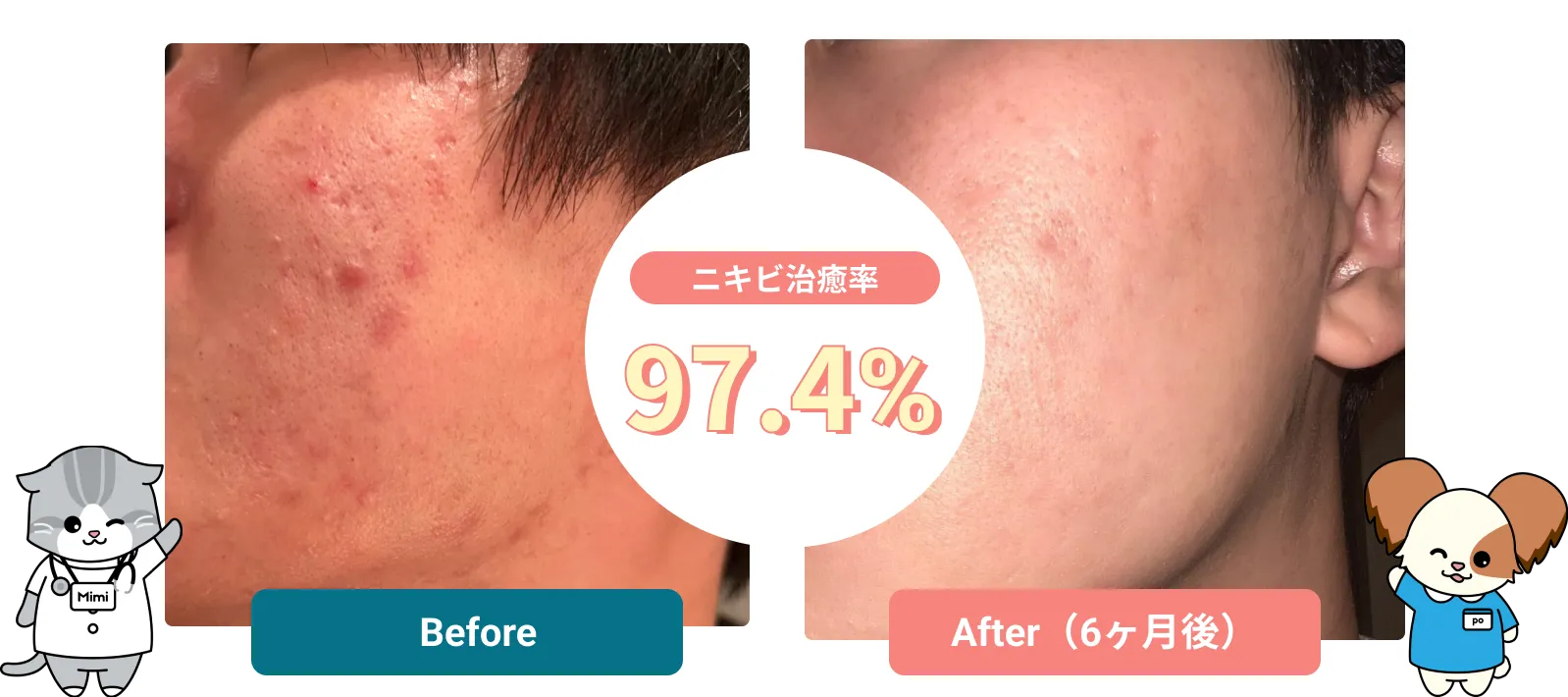 ニキビ治療率97.4%