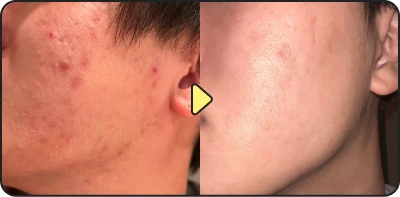 Acne treatment before and after - Case 1