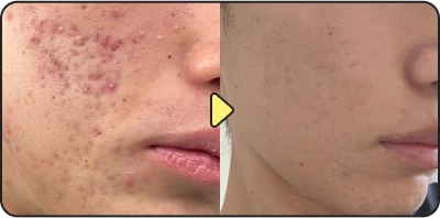 Acne treatment before and after - Case 2