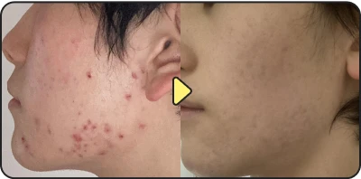 Acne treatment before and after - Case 3