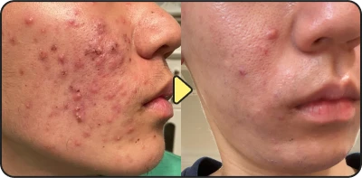 Acne treatment before and after - Case 4