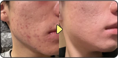 Acne treatment before and after - Case 5