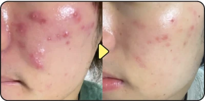 Acne treatment before and after - Case 6