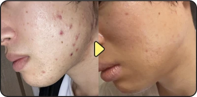 Acne treatment before and after - Case 7