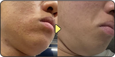 Acne treatment before and after - Case 8