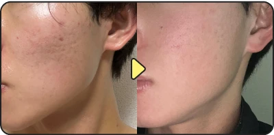 Acne treatment before and after - Case 9