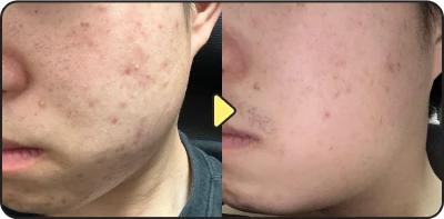 Acne treatment before and after - Case 10