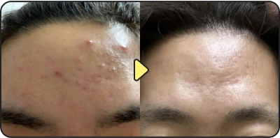 Acne treatment before and after - Case 11