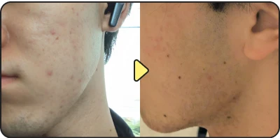 Acne treatment before and after - Case 12
