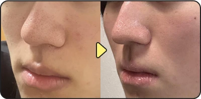 Acne treatment before and after - Case 13