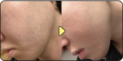 Acne treatment before and after - Case 14