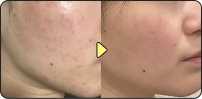 Acne treatment result - Case 15