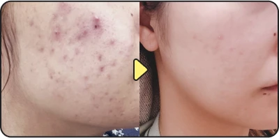 Acne treatment result - Case 16