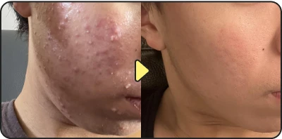 Acne treatment result - Case 17