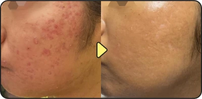 Acne treatment result - Case 18