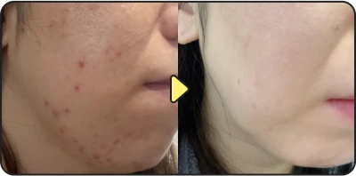 Acne treatment result - Case 19