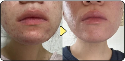 Acne treatment result - Case 20