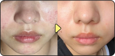 Acne treatment result - Case 21
