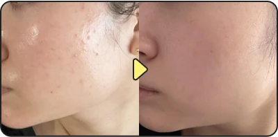 Acne treatment result - Case 22