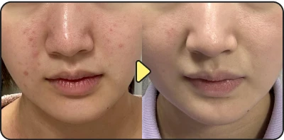 Acne treatment result - Case 23