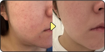 Acne treatment result - Case 24