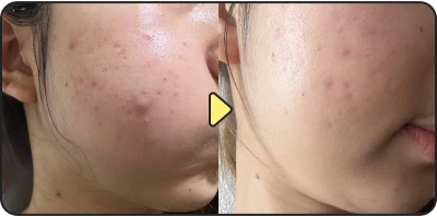 Acne treatment result - Case 25