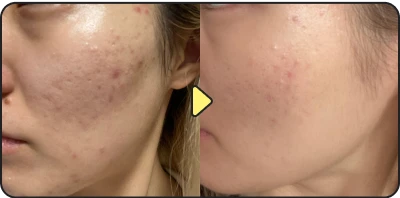Acne treatment result - Case 26