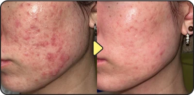 Acne treatment result - Case 27