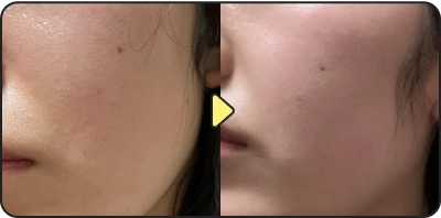 Acne treatment result - Case 28