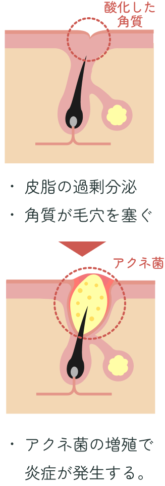 皮脂で毛穴が詰まりニキビができた断面図