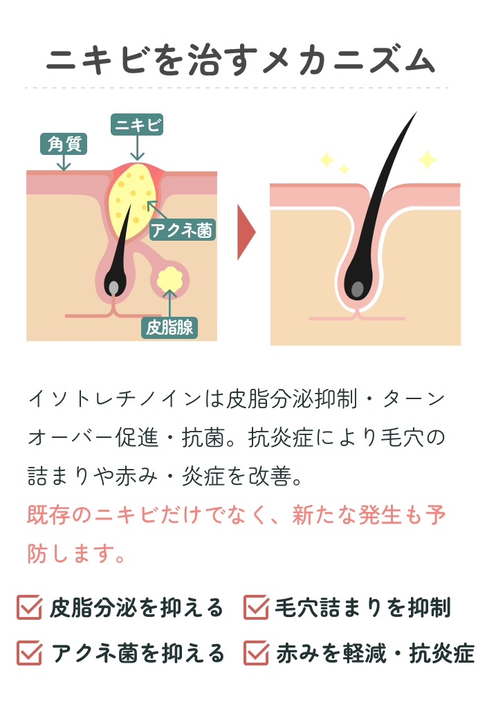 ニキビを治すメカニズム。イソトレチノインは皮脂分泌抑制・ターンオーバー促進・抗菌・抗炎症により毛穴の詰まりや赤み・炎症を改善し、新たな発生も予防します